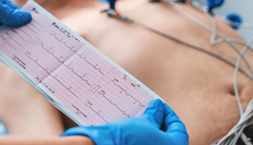ECG